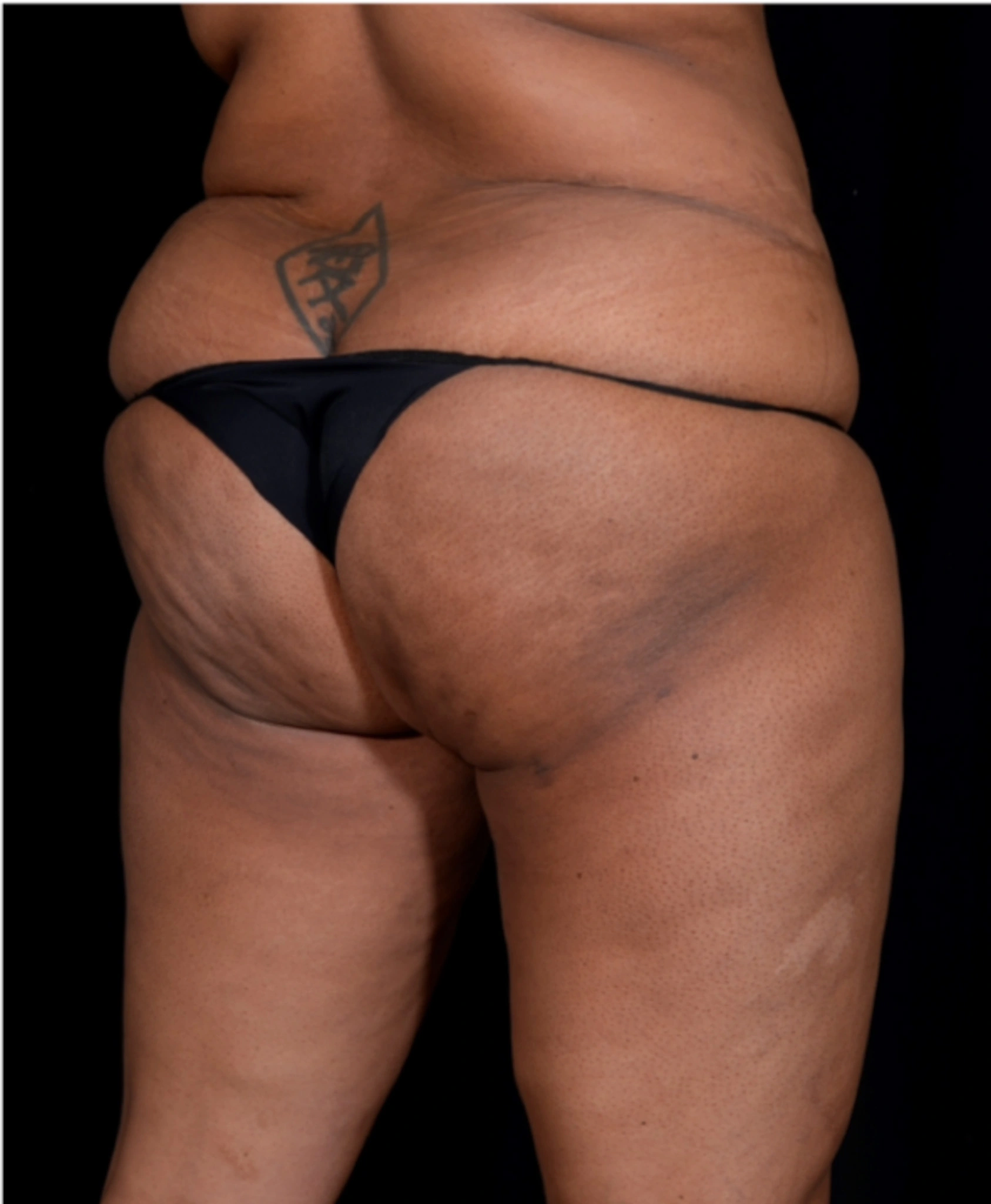 Brazilian-Butt-Lift-Case--7979 | Before Brazilian Butt Lift 2