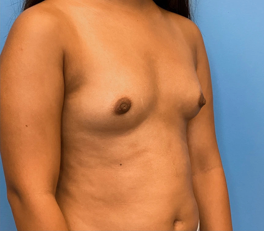 Breast-Augmentation-Case--1115 | Before Breast Augmentation 5