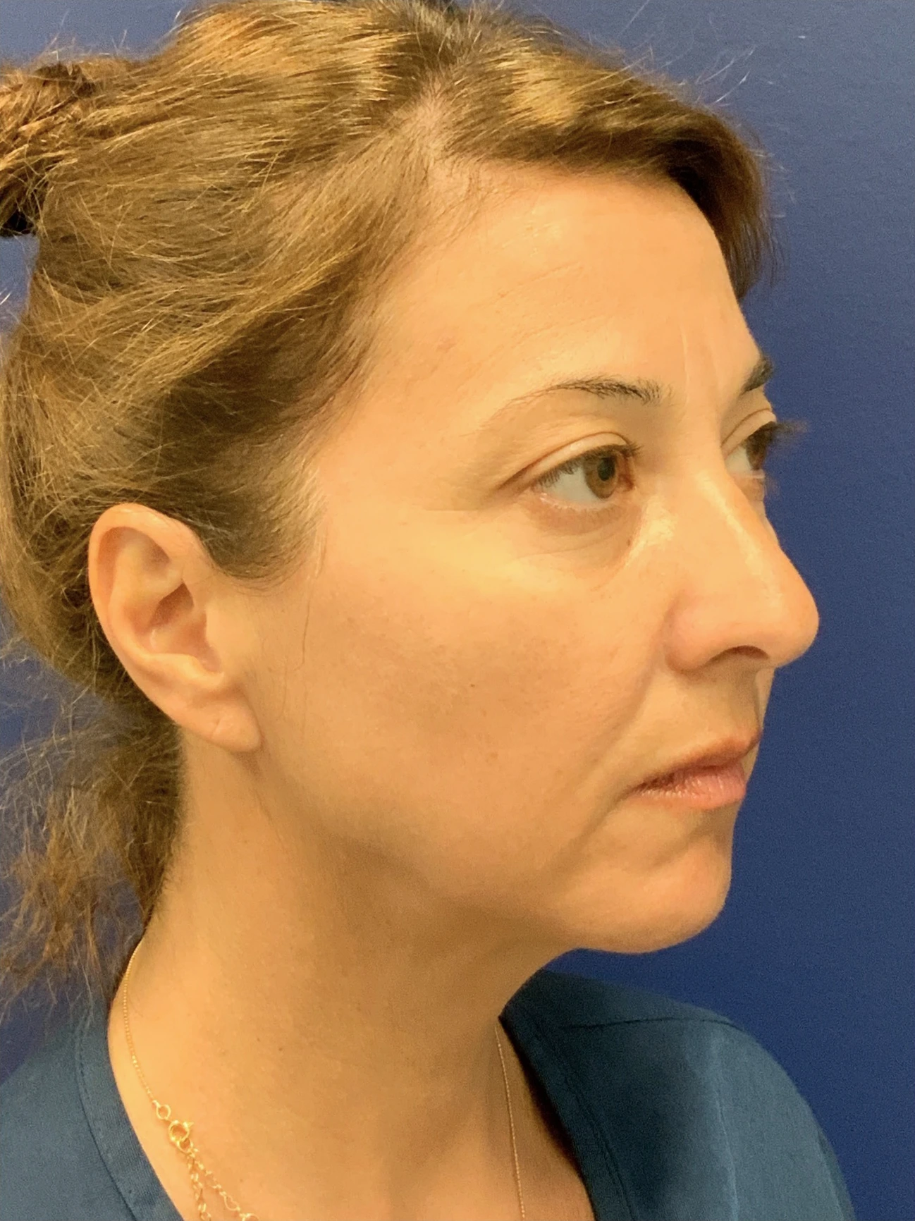 Facelift-Case--8368 | Before Facelift 5