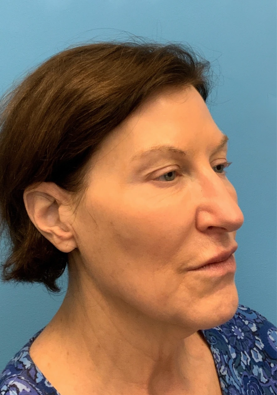 Facelift-Case--6591 | Before Facelift 5