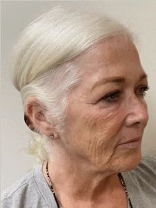 Facelift-Case--8874 | Before Dr. Arjun Kanuri 2