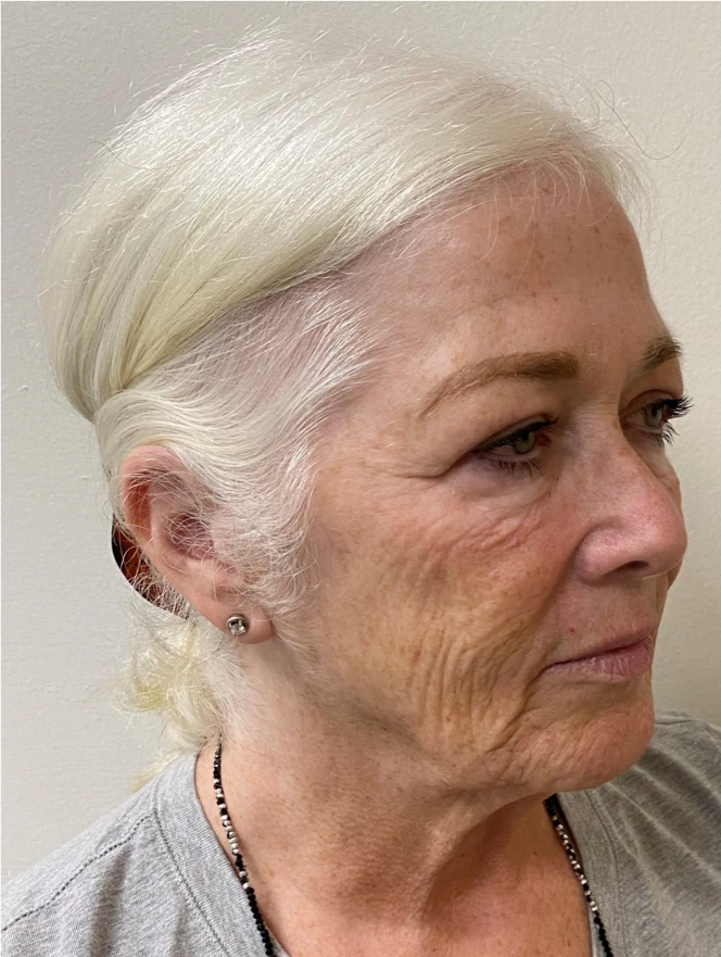 Facelift-Case--8874 | Before Facelift 2