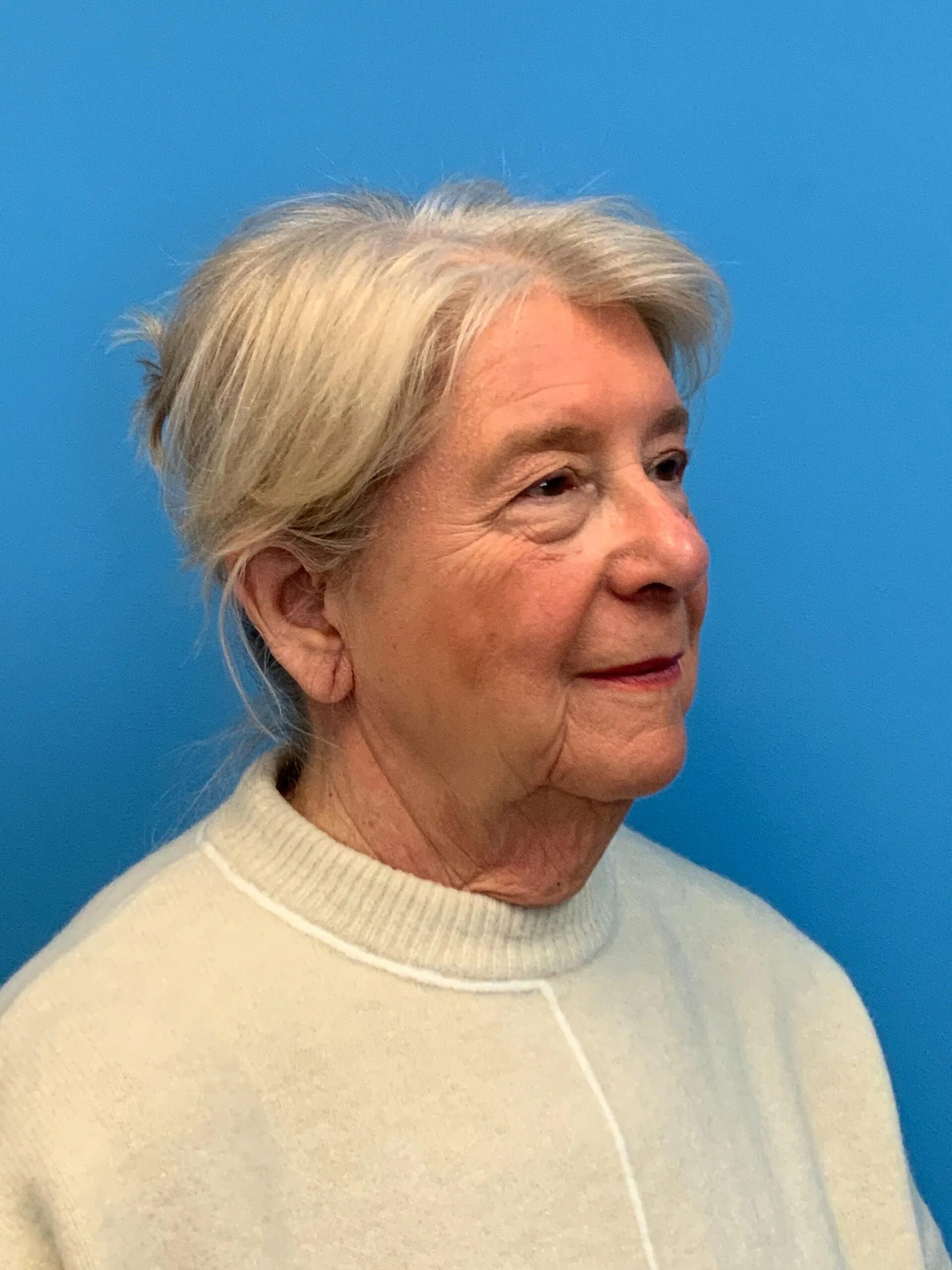 Facelift-Case--6034 | Before Facelift 4