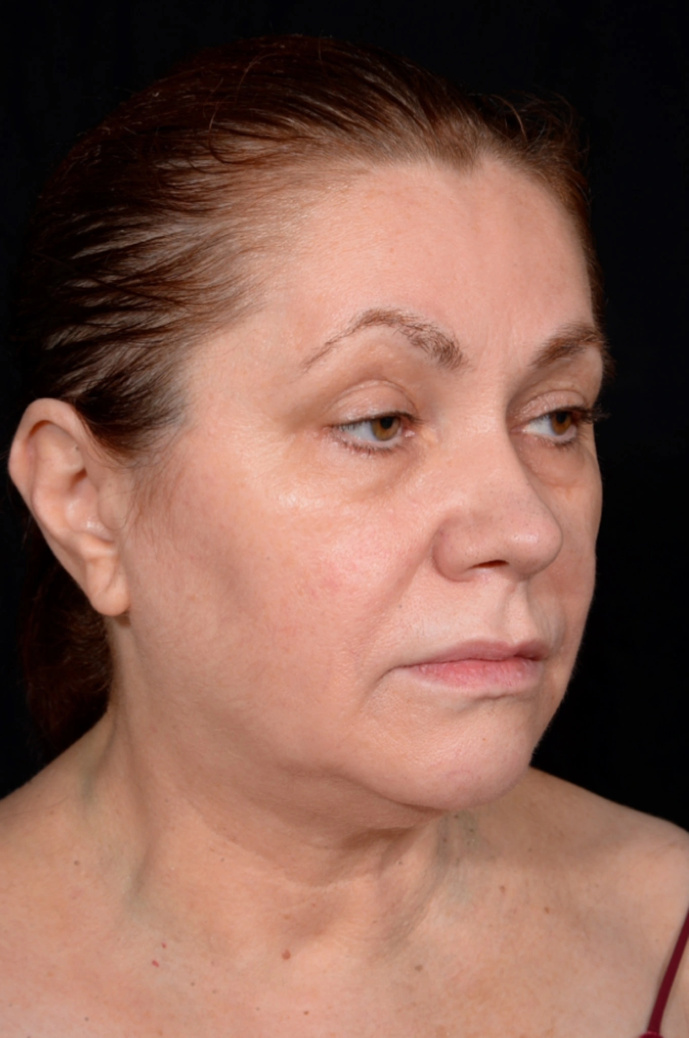 Facelift-Case--6254 | Before Facelift 3