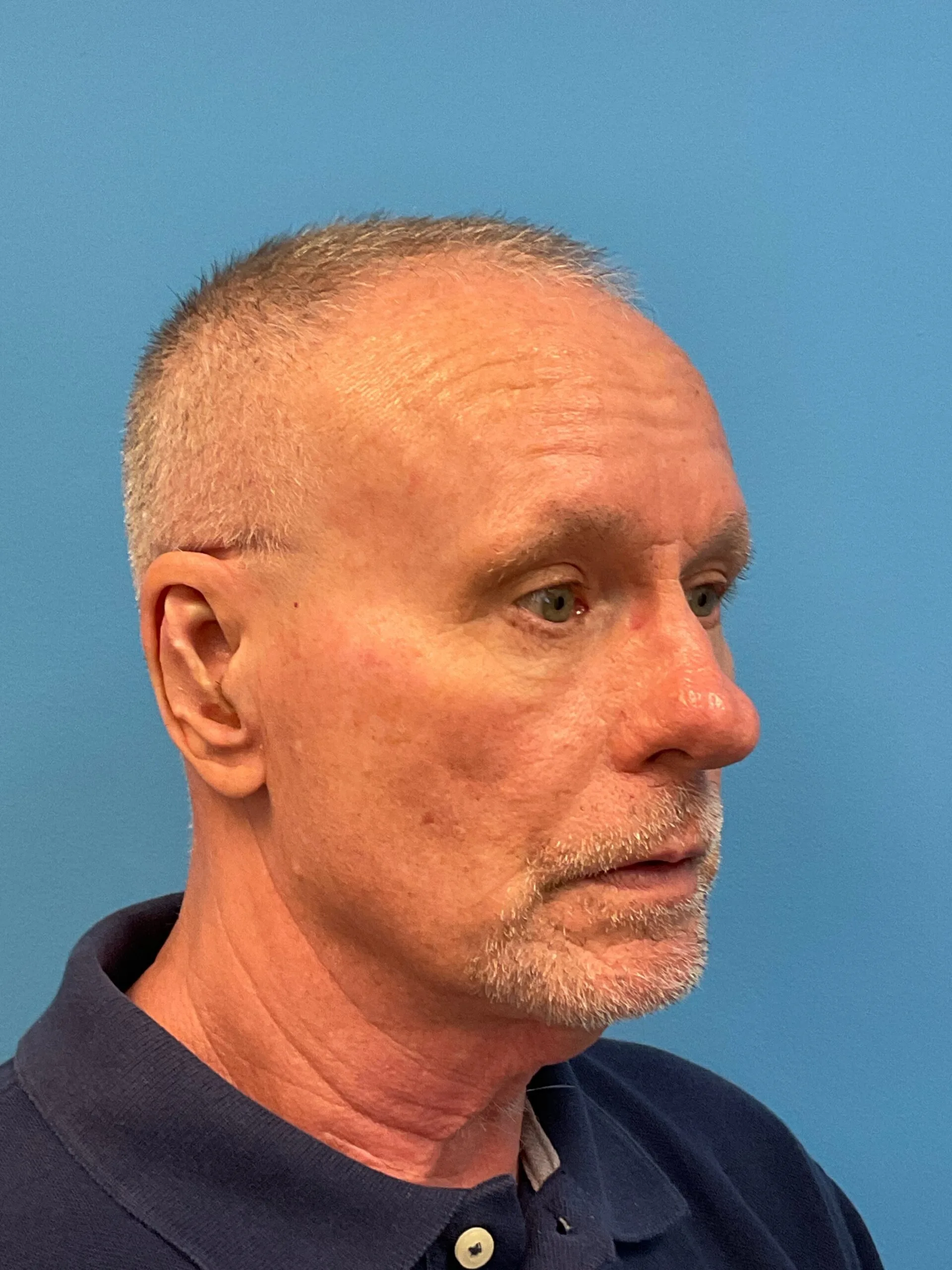 Rhinoplasty-Case--3129 | Before Rhinoplasty 5