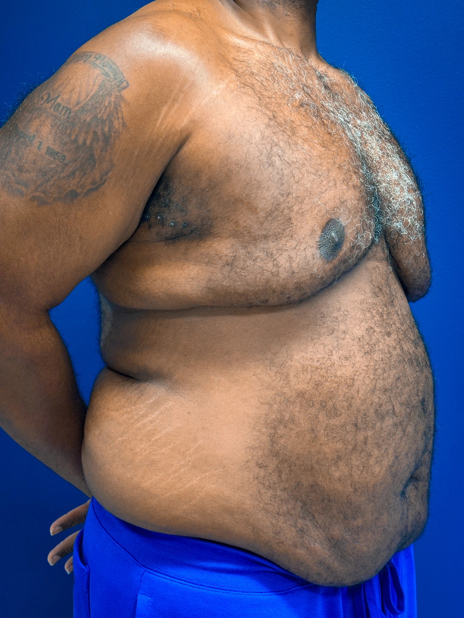 Gynecomastia-Case--4473 | Before Gynecomastia / Male Breast Reduction 4