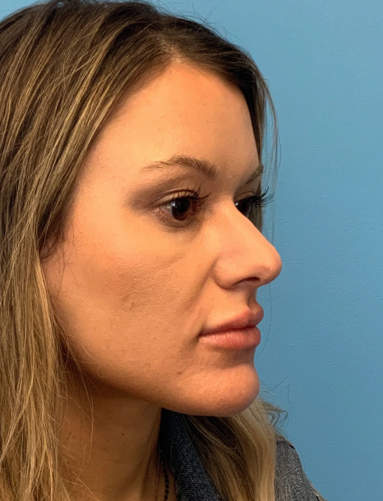 Rhinoplasty-Case--4972 | Before Rhinoplasty 6