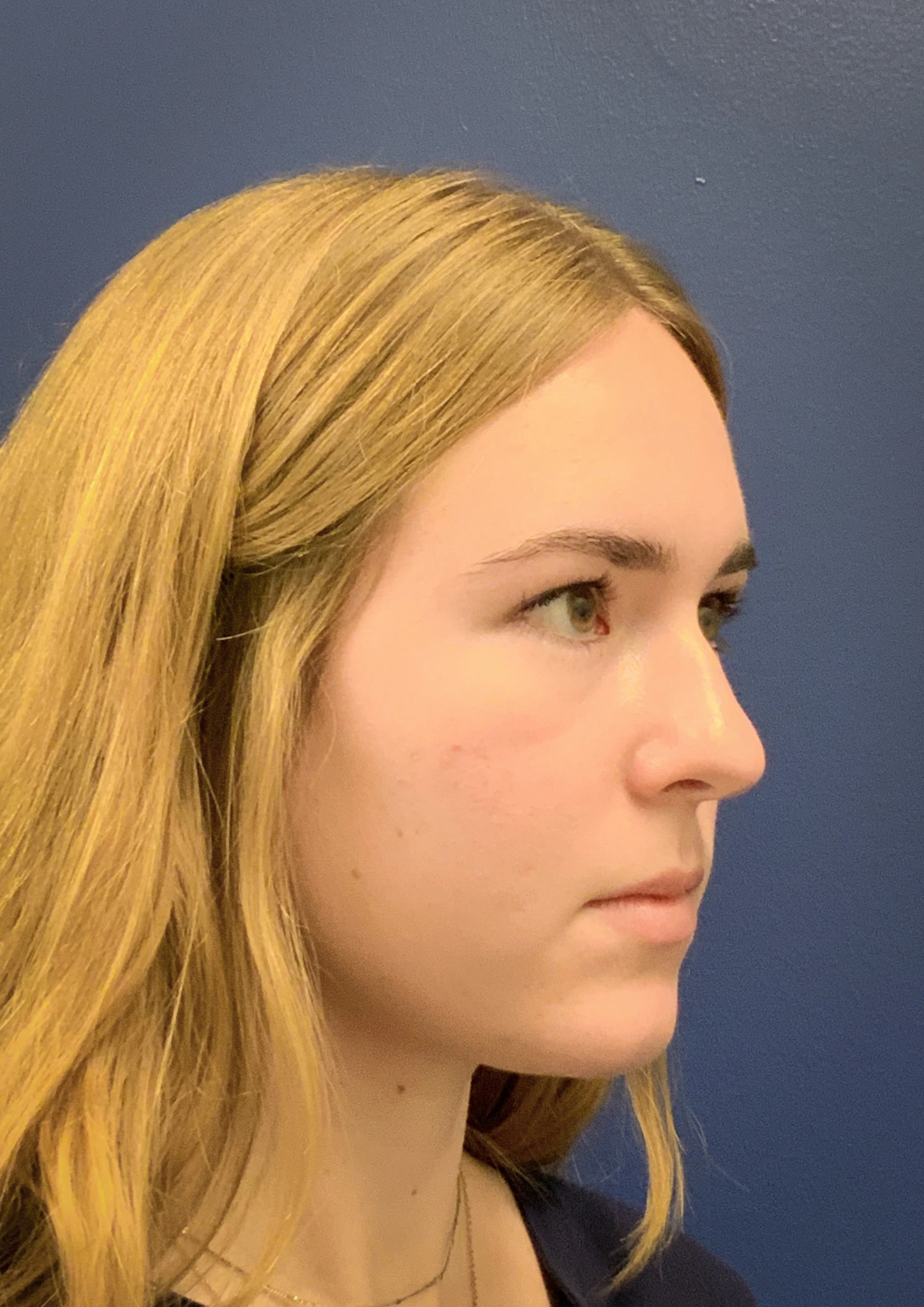 Rhinoplasty-Case--6484 | Before Rhinoplasty 4