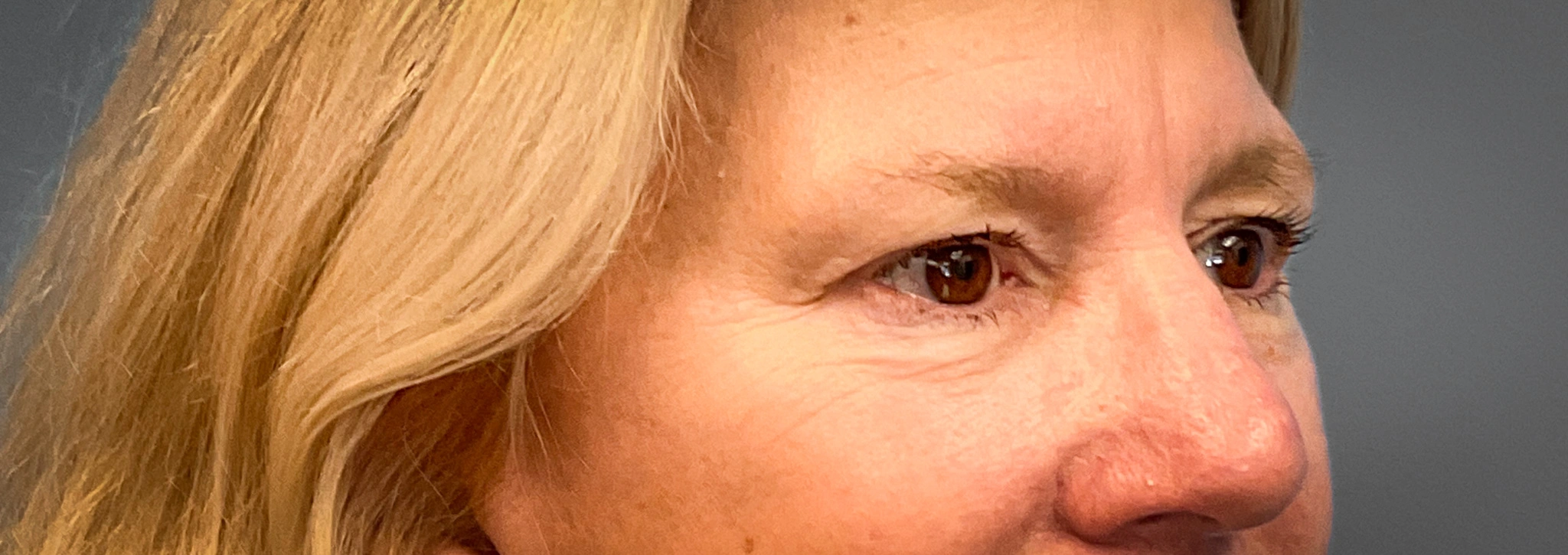 Blepharoplasty-Case--2653 | Before Eyelid Surgery 3
