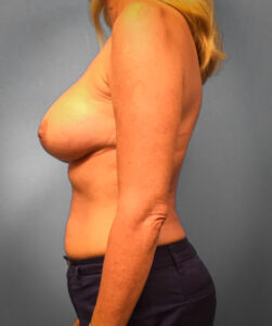 After Breast Augmentation (Side)