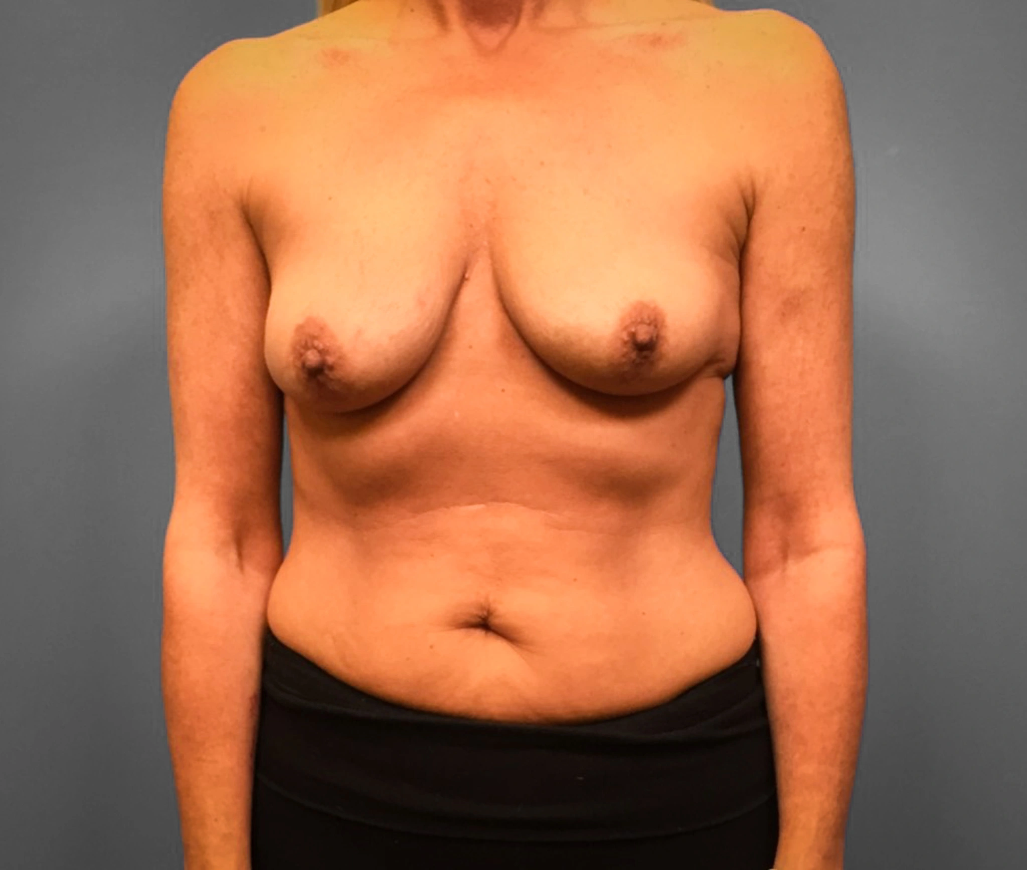 Before Breast Augmentation (Front)