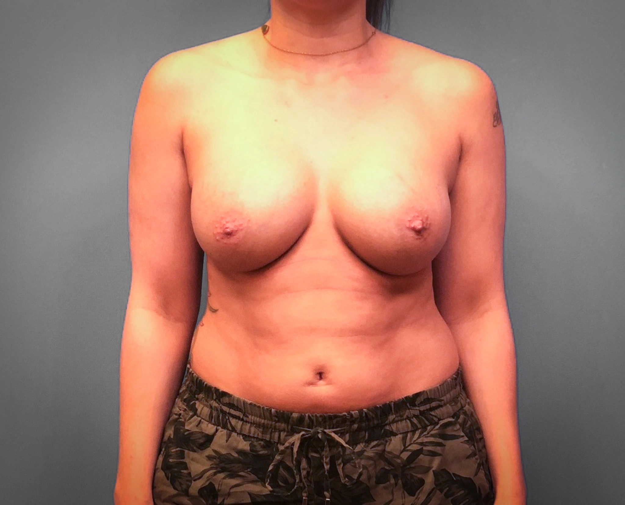 After Breast Augmentation (Front)