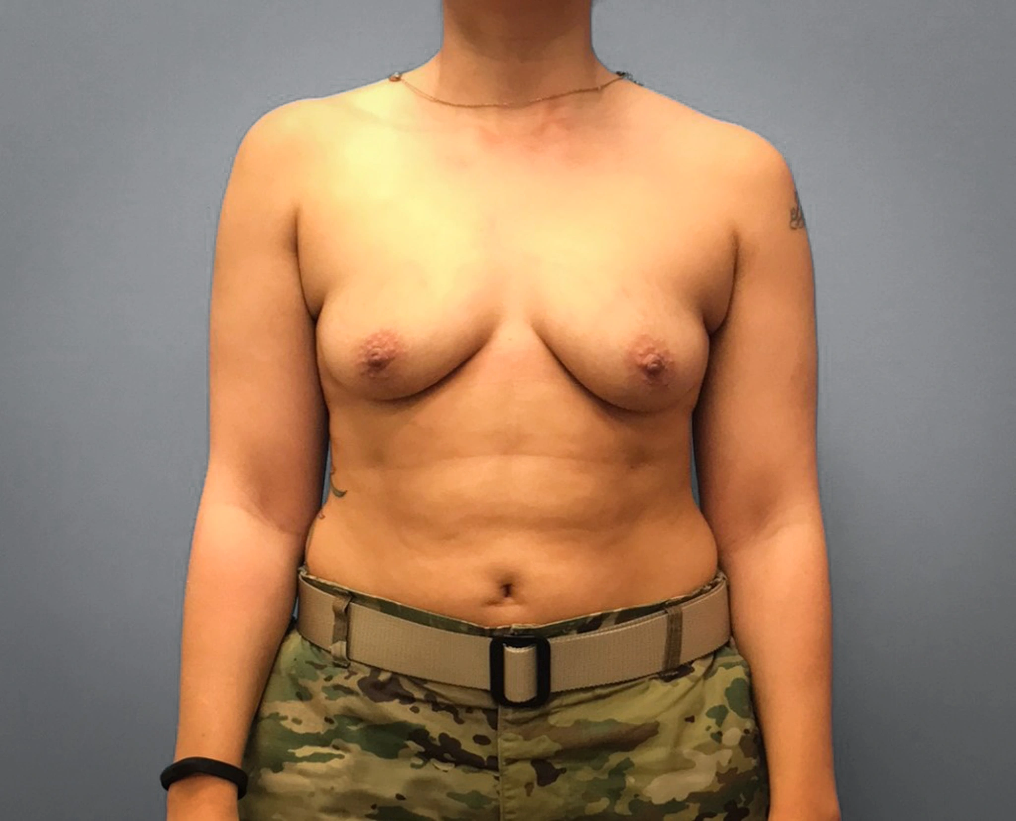 Before Breast Augmentation (Front)