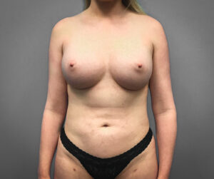 After Breast Augmentation (Front)