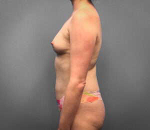 Before Breast Augmentation (Side)