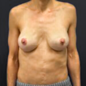 After Breast Reconstruction (Front Profile)