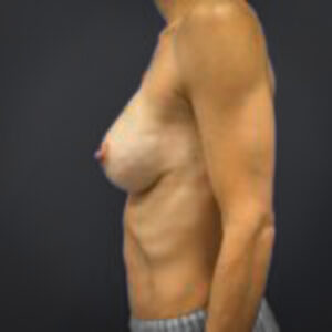 After Breast Reconstruction (Side Profile)