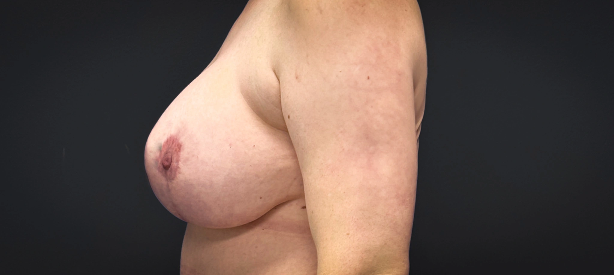 Augmentation-Mastopexy-Case--2453 | After Breast Reconstruction 3