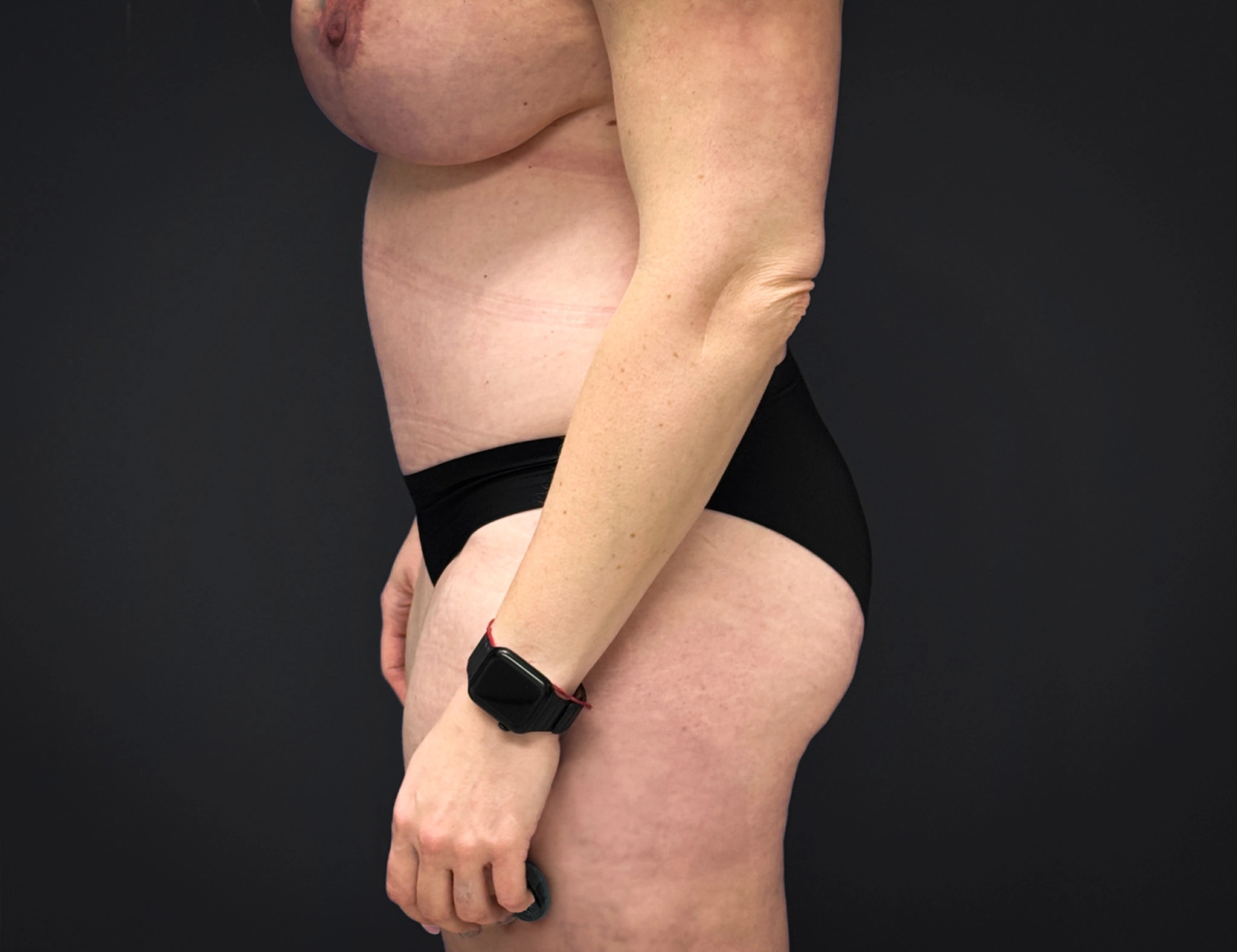 Abdominoplasty-Liposuction-Flanks-Case--6546 | After Liposuction 2