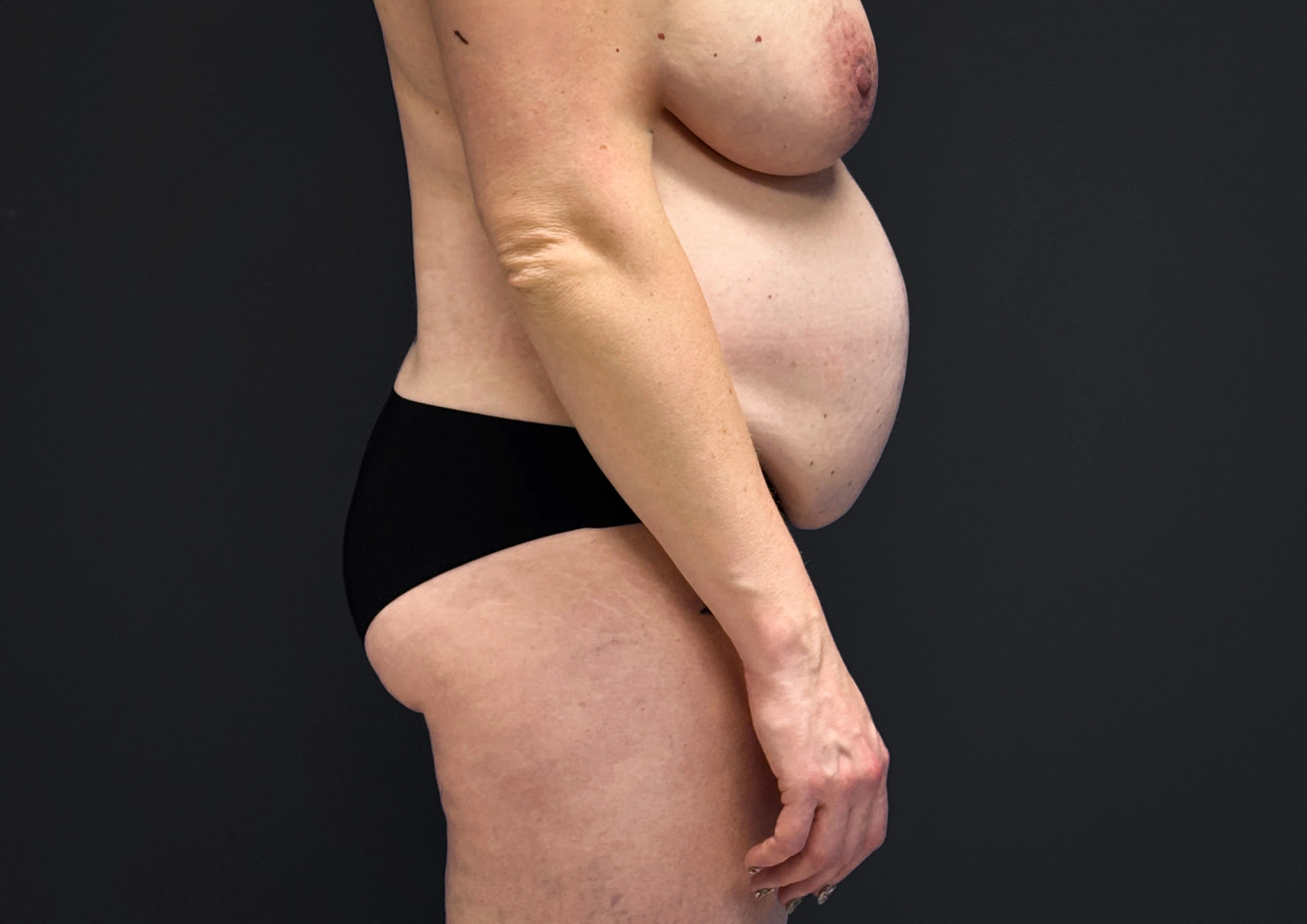 Abdominoplasty-Liposuction-Flanks-Case--6546 | Before Liposuction 3