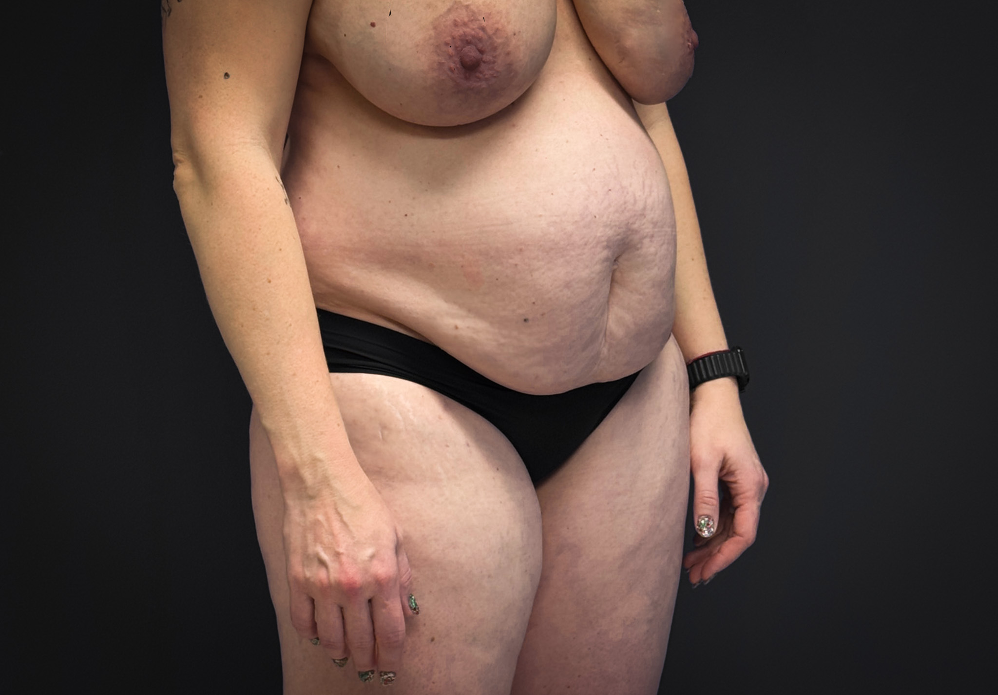 Abdominoplasty-Liposuction-Flanks-Case--6546 | Before Liposuction 4