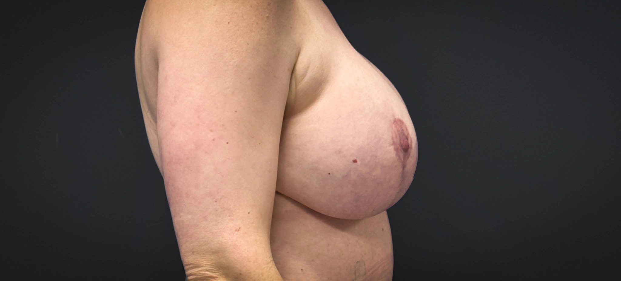 Augmentation-Mastopexy-Case--2453 | After Breast Reconstruction 2