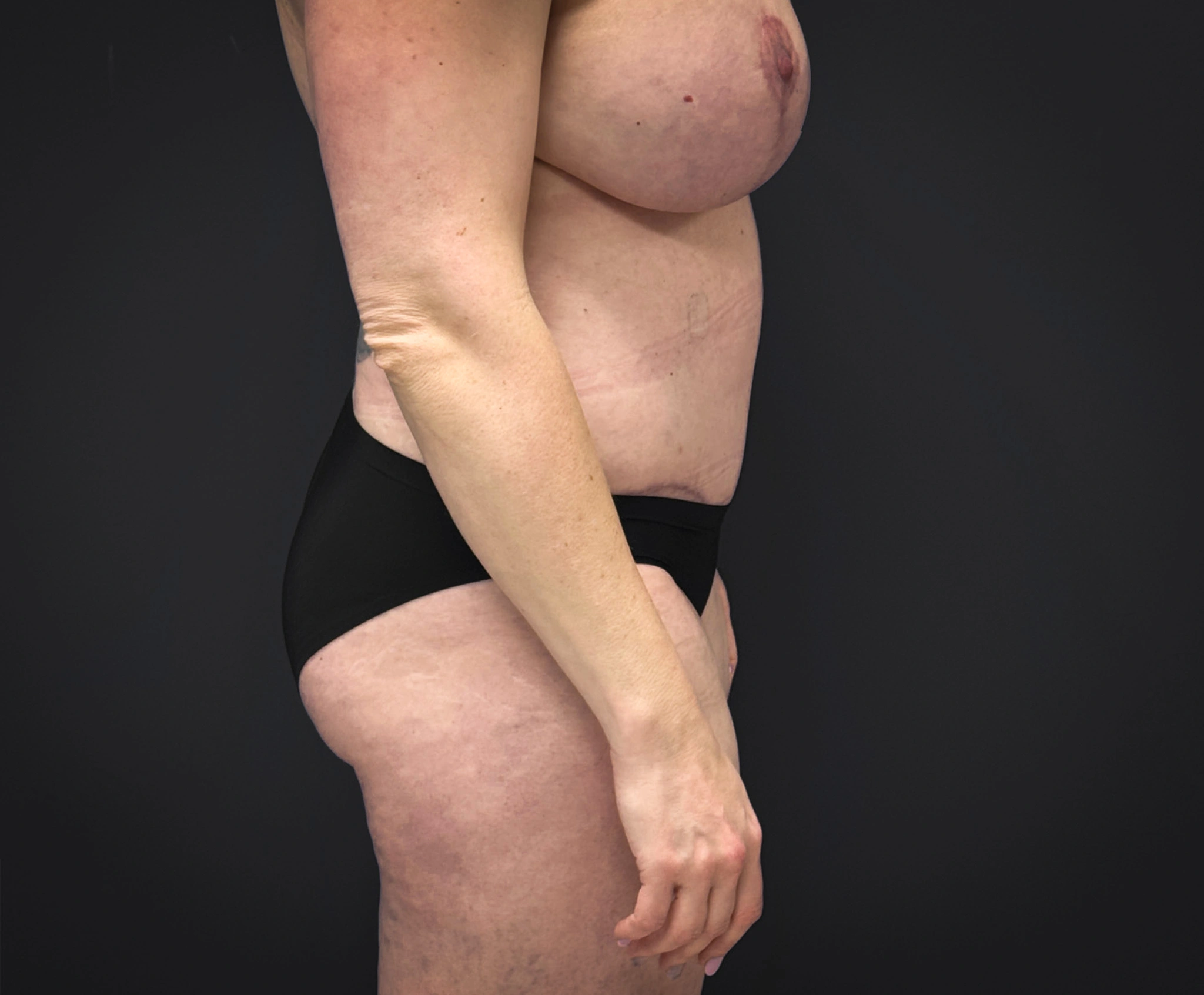 Abdominoplasty-Liposuction-Flanks-Case--6546 | After Liposuction 3