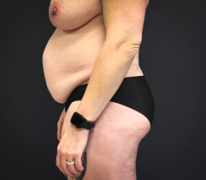 Abdominoplasty-Liposuction-Flanks-Case--6546 | Before Liposuction 2