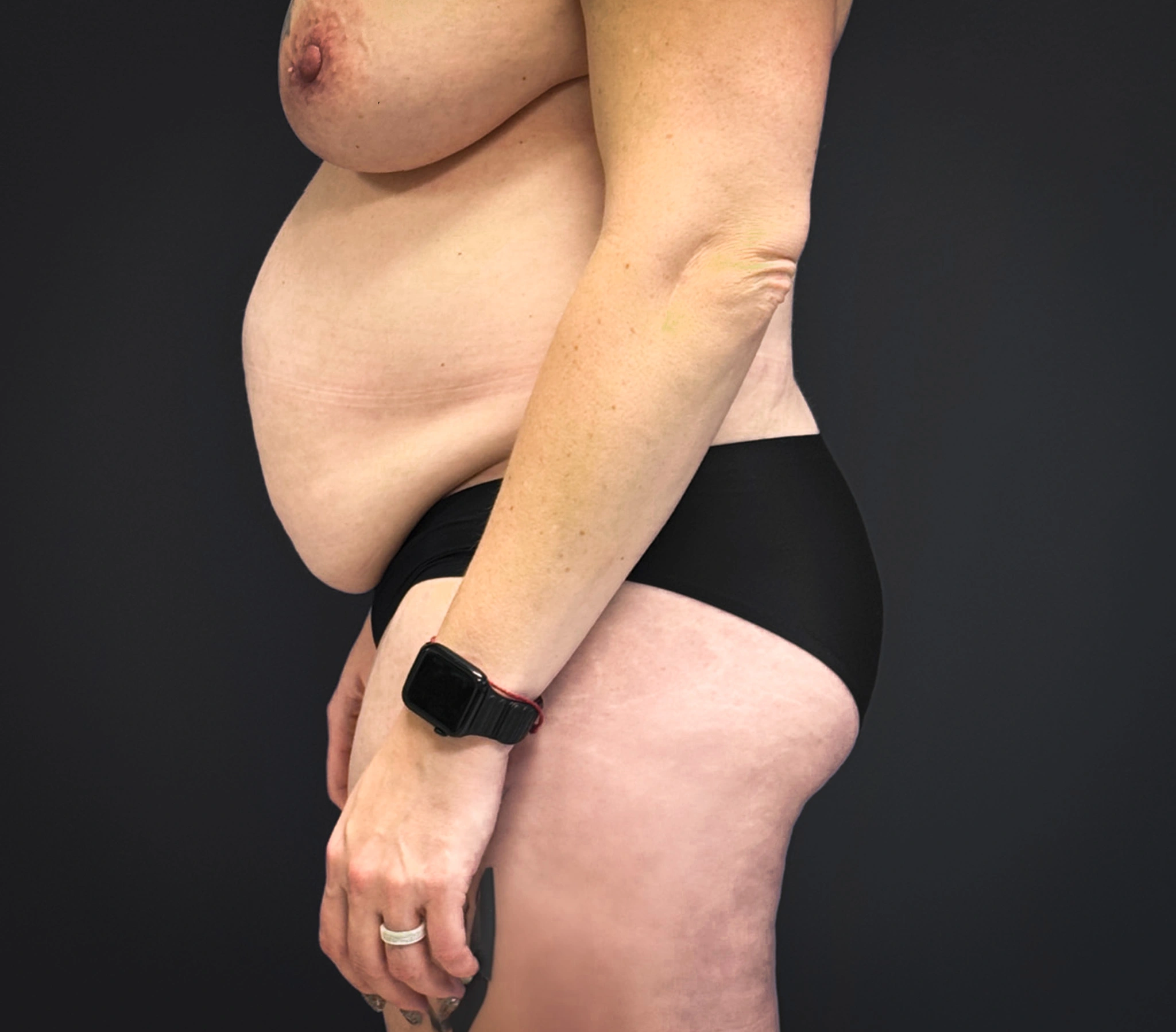 Abdominoplasty-Liposuction-Flanks-Case--6546 | Before Liposuction 2