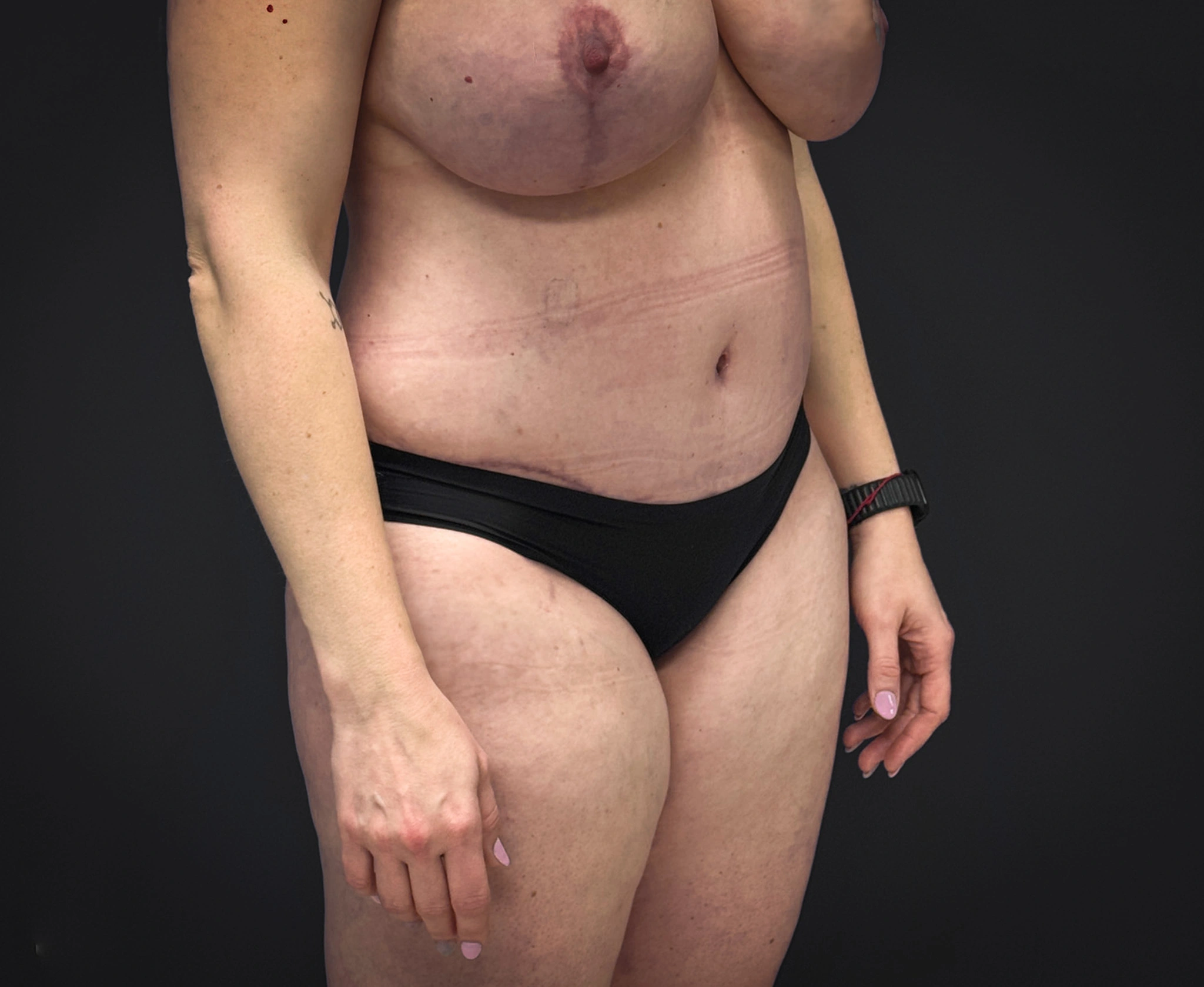 Abdominoplasty-Liposuction-Flanks-Case--6546 | After Liposuction 4