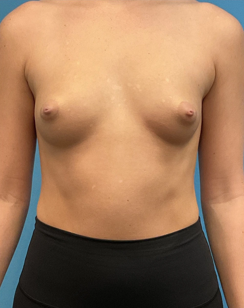 Breast-Augmentation-Case--28179 | Before Breast Augmentation 1