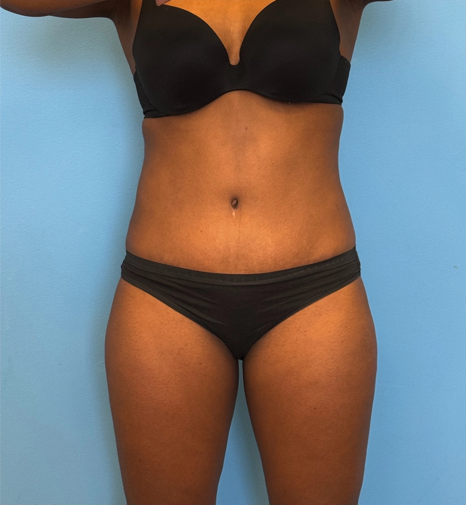 Abdominoplasty-Case--28134 | After Tummy Tuck 1