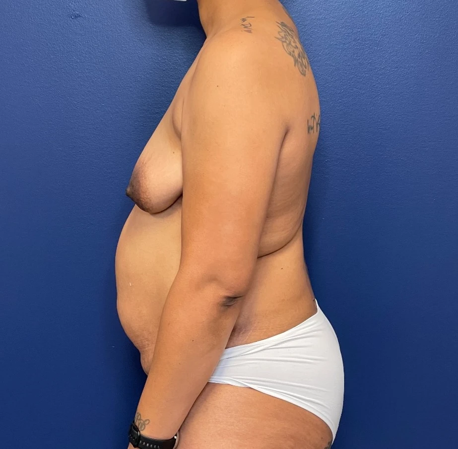 Before Mommy Makeover (Side)