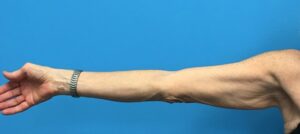 Before photo of patient undergoing an arm lift