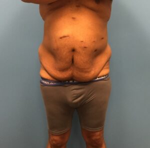 Front view of patient before undergoing a body lift procedure