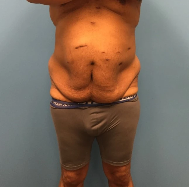 Front view of patient before undergoing a body lift procedure