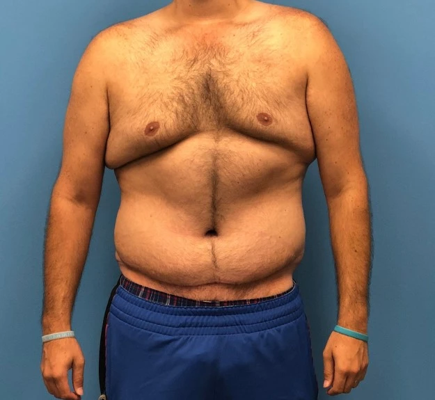 Front view of patient after undergoing a body lift procedure