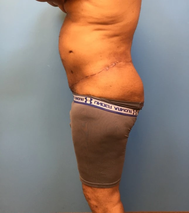 Side profile of patient before undergoing a body lift procedure