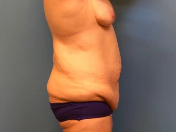 Body-Lift-Case--5433 | Before Body Lift 1