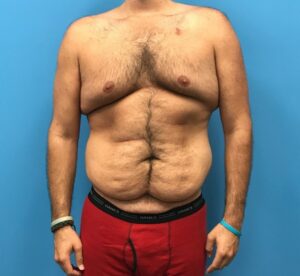 Front view of patient before undergoing a body lift procedure