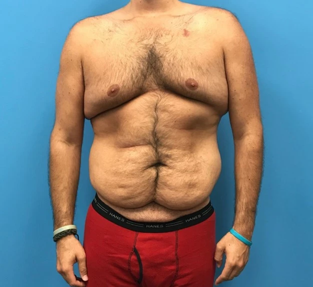 Front view of patient before undergoing a body lift procedure