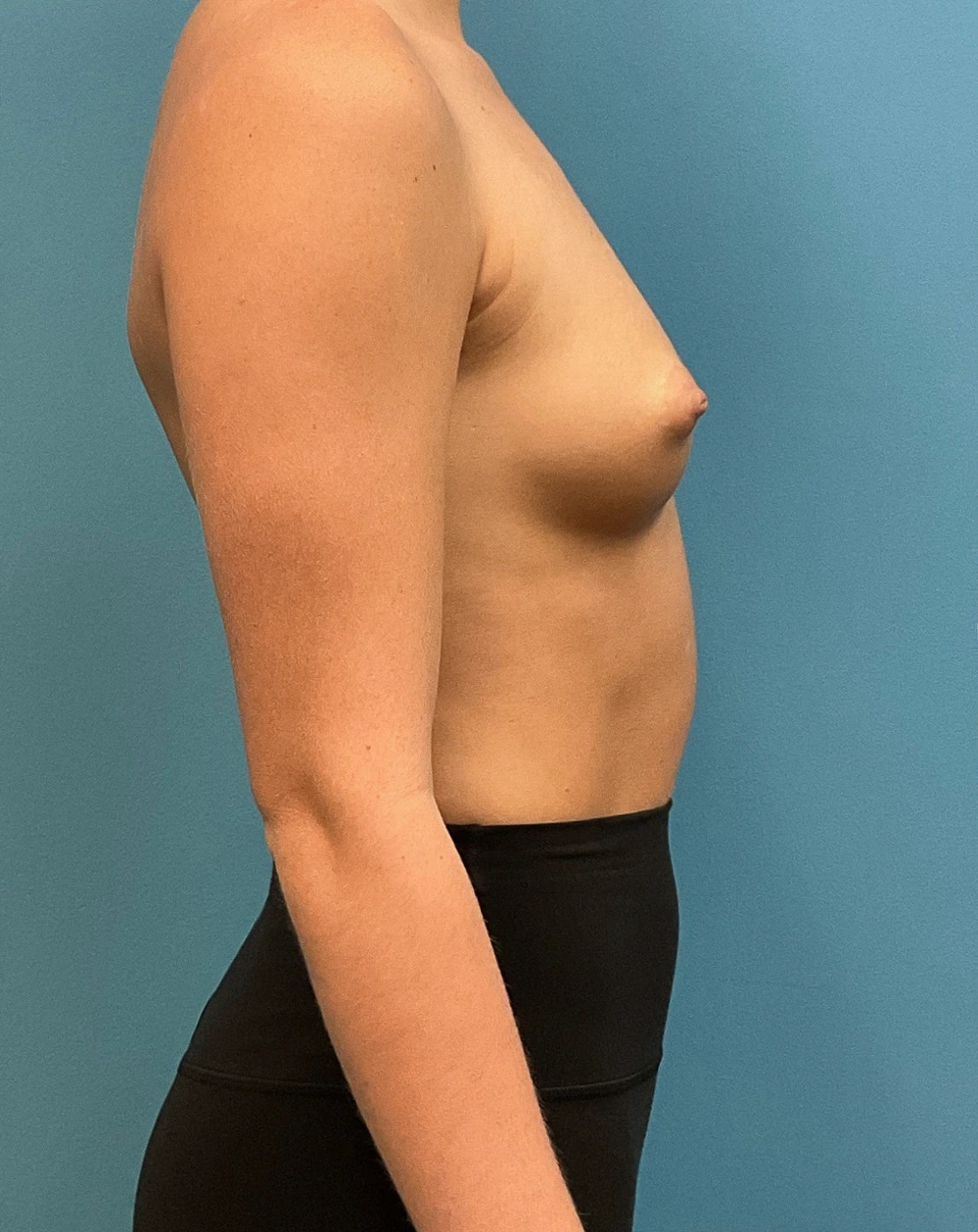 Breast-Augmentation-Case--28179 | Before Breast Augmentation 5