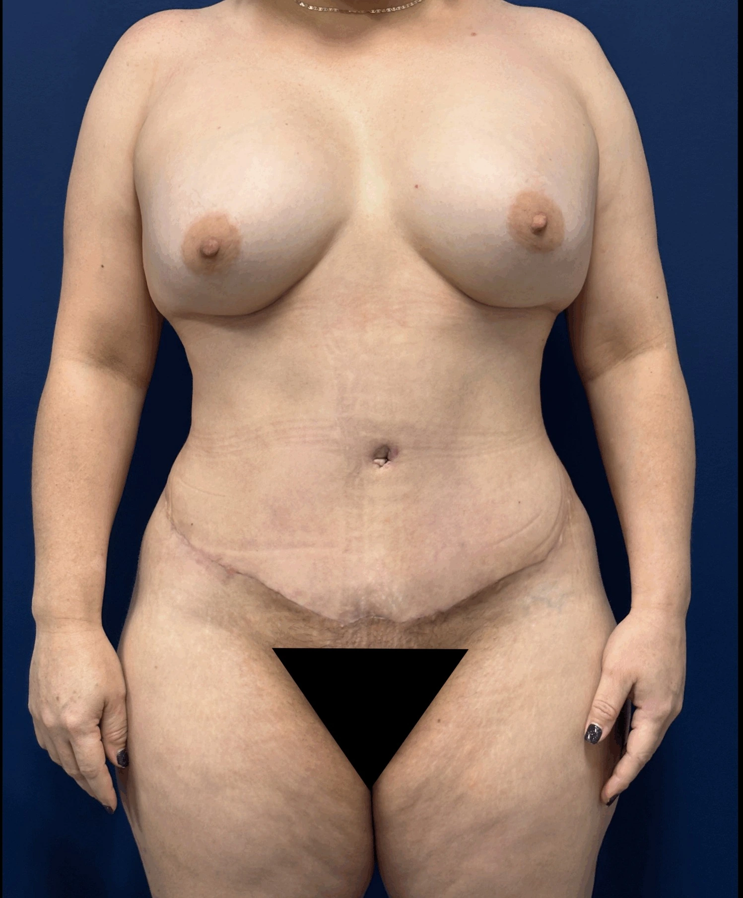 Abdominoplasty-Case--1259 | After Tummy Tuck 1