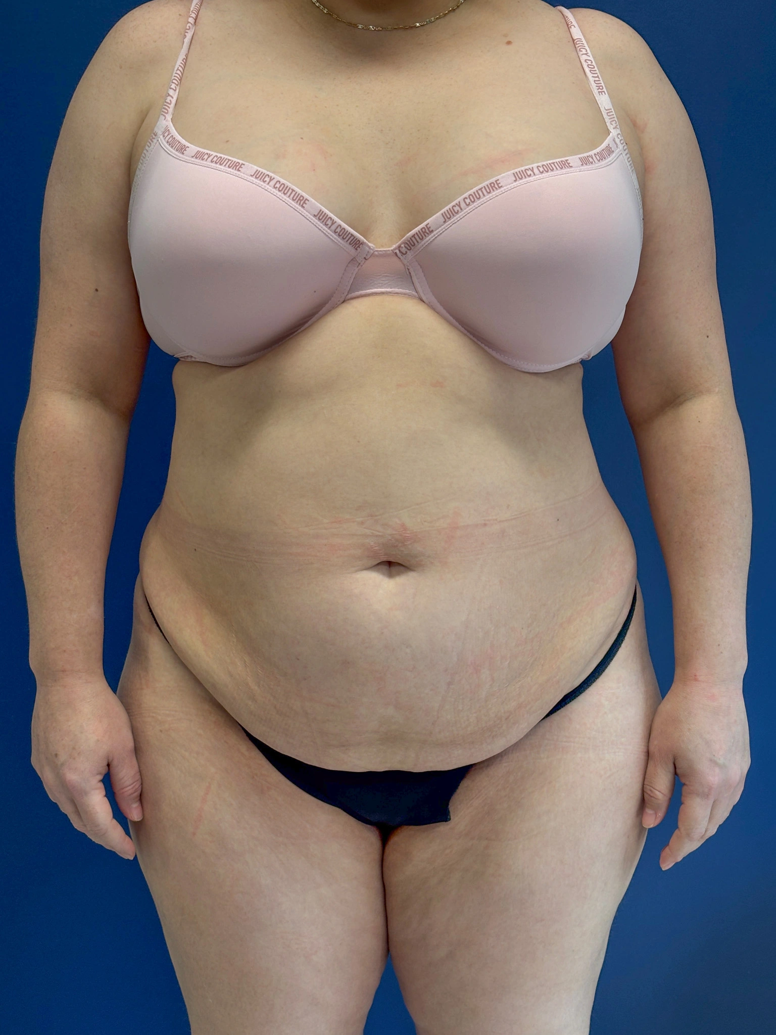 Abdominoplasty-Case--1259 | Before Tummy Tuck 1