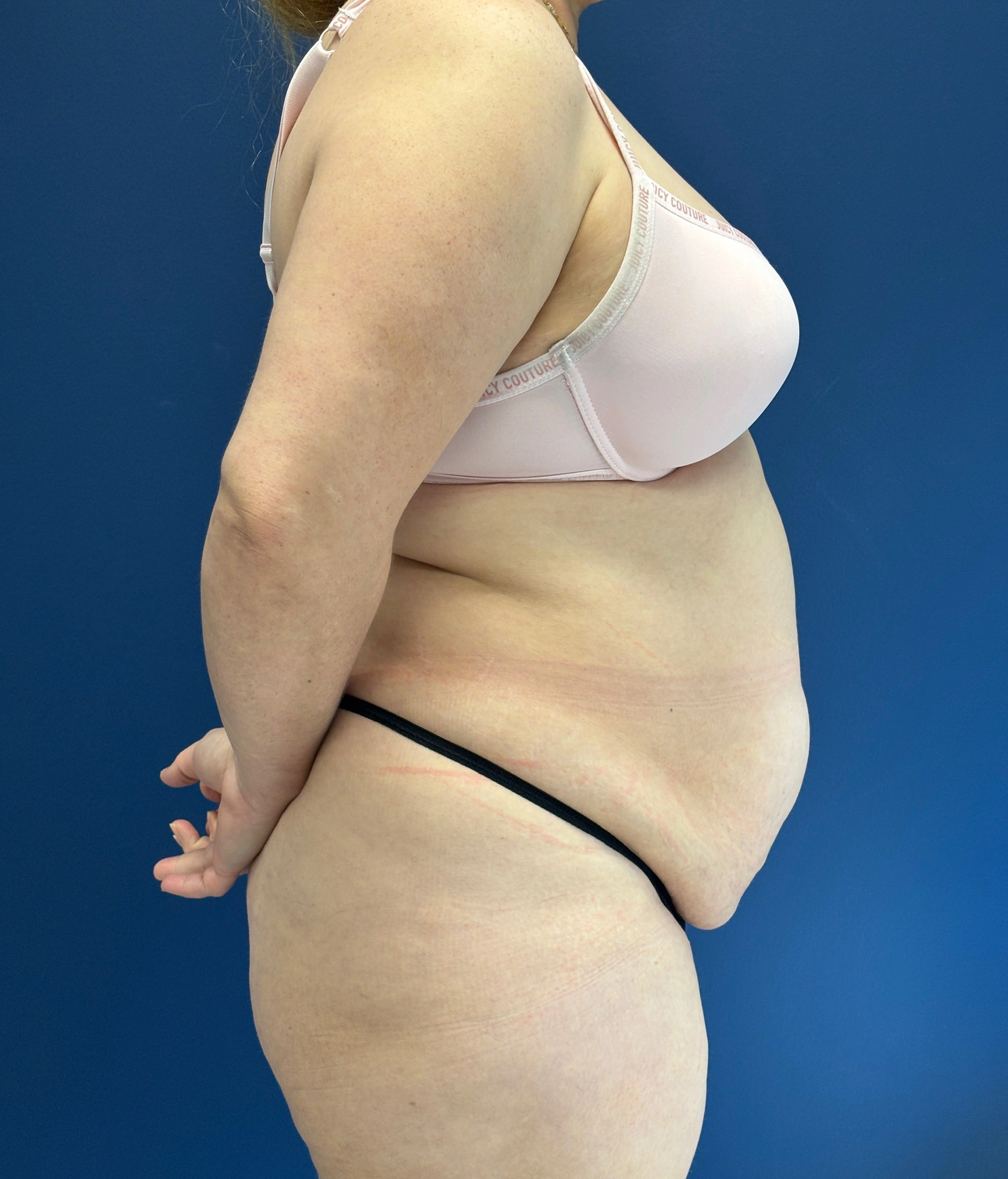 Abdominoplasty-Case--1259 | Before Tummy Tuck 2