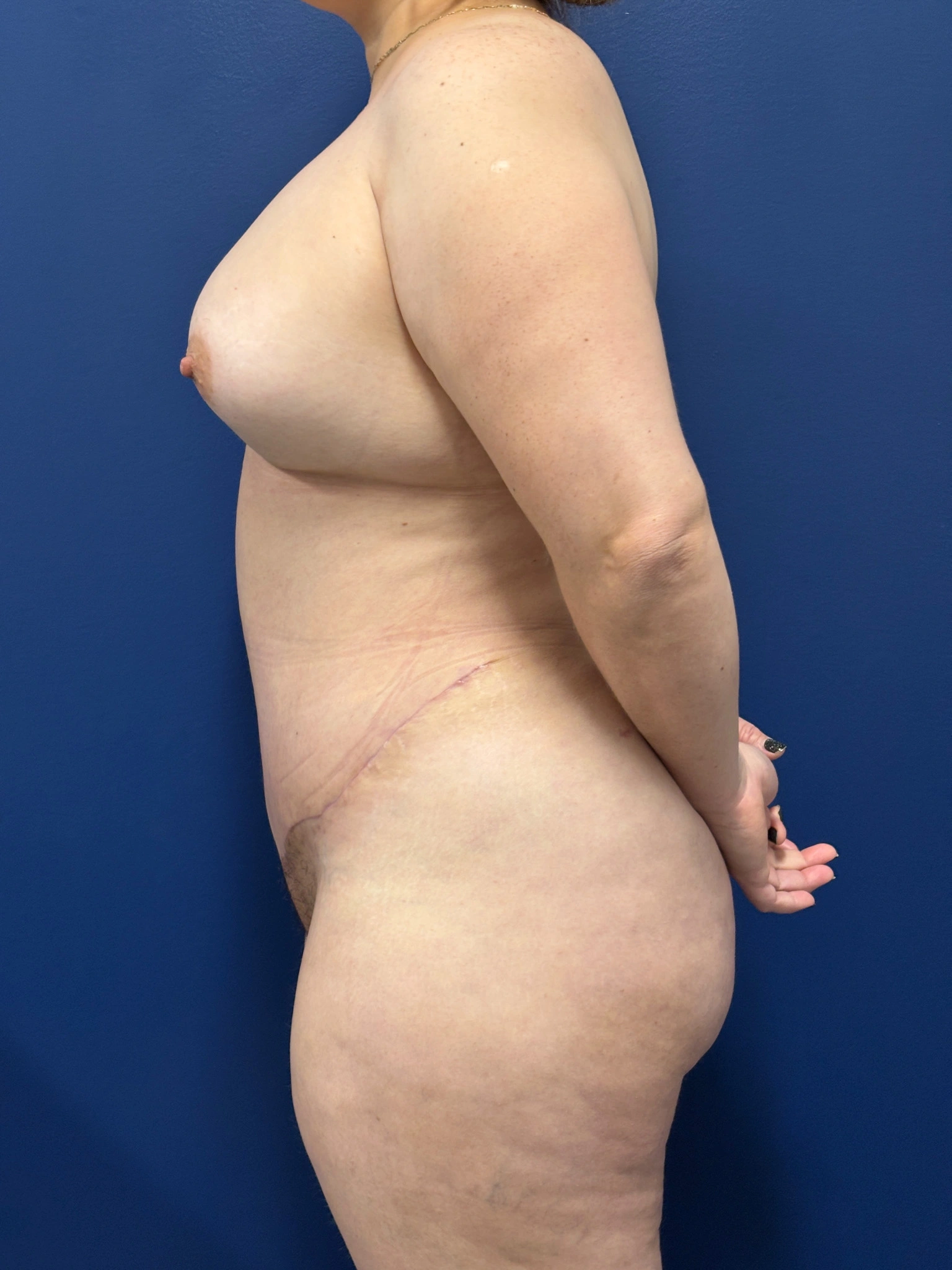 Abdominoplasty-Case--1259 | After Tummy Tuck 3