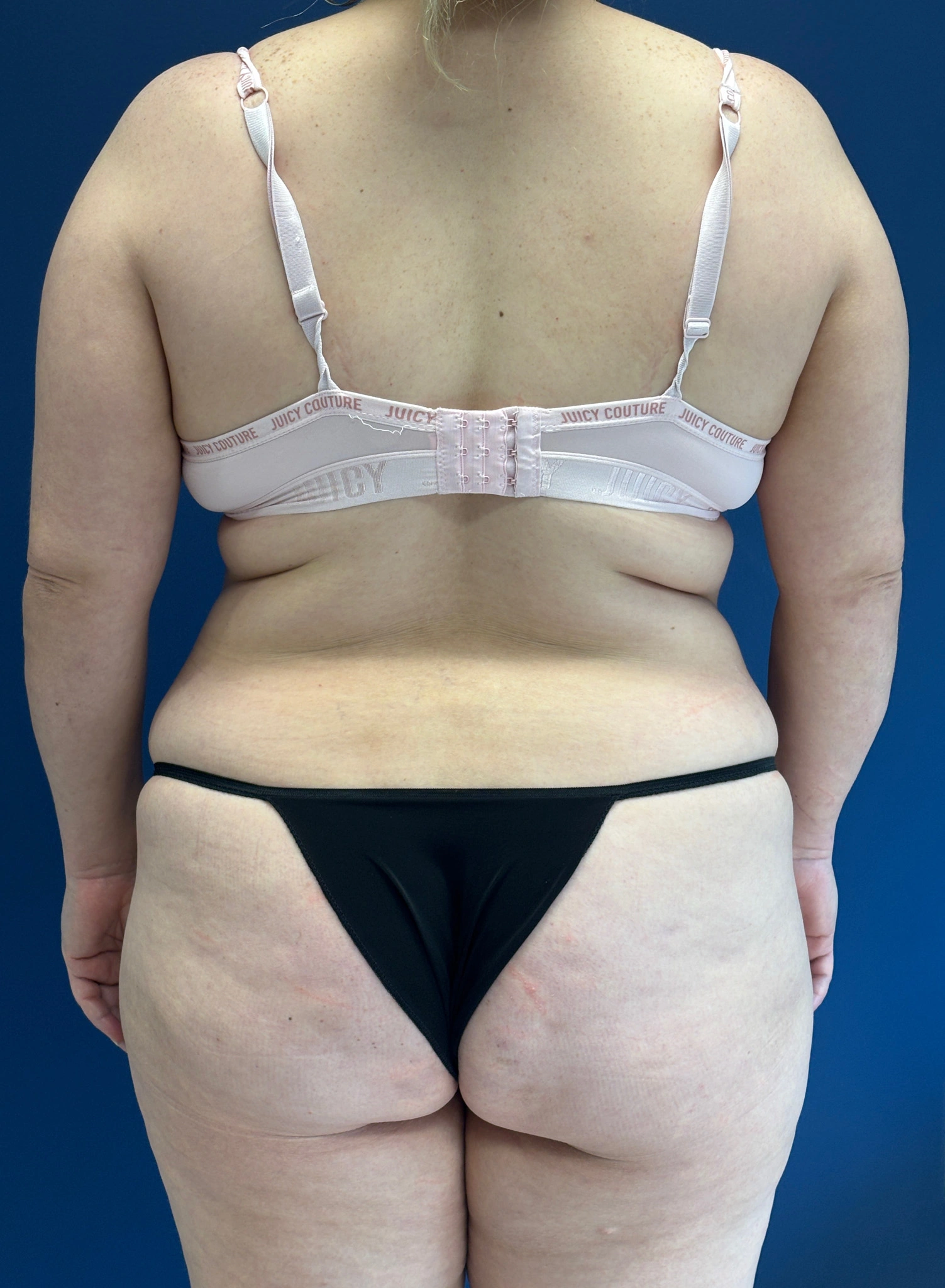 Brazilian-Butt-Lift-Case--9569 | Before Brazilian Butt Lift 1