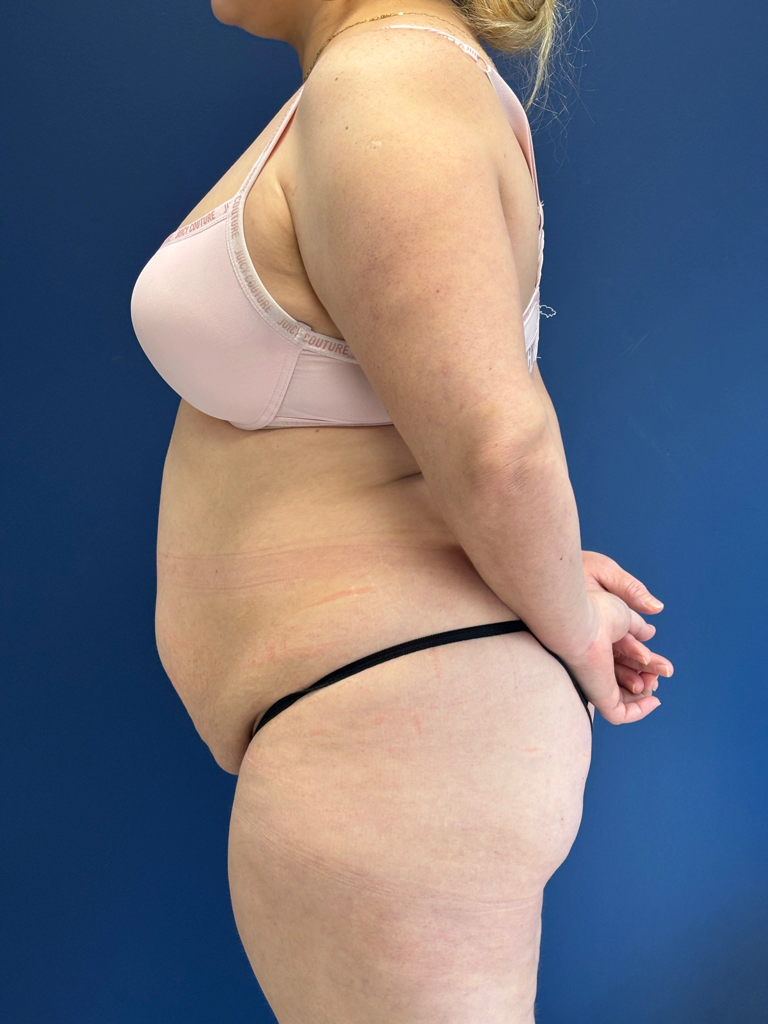 Brazilian-Butt-Lift-Case--9569 | Before Brazilian Butt Lift 2