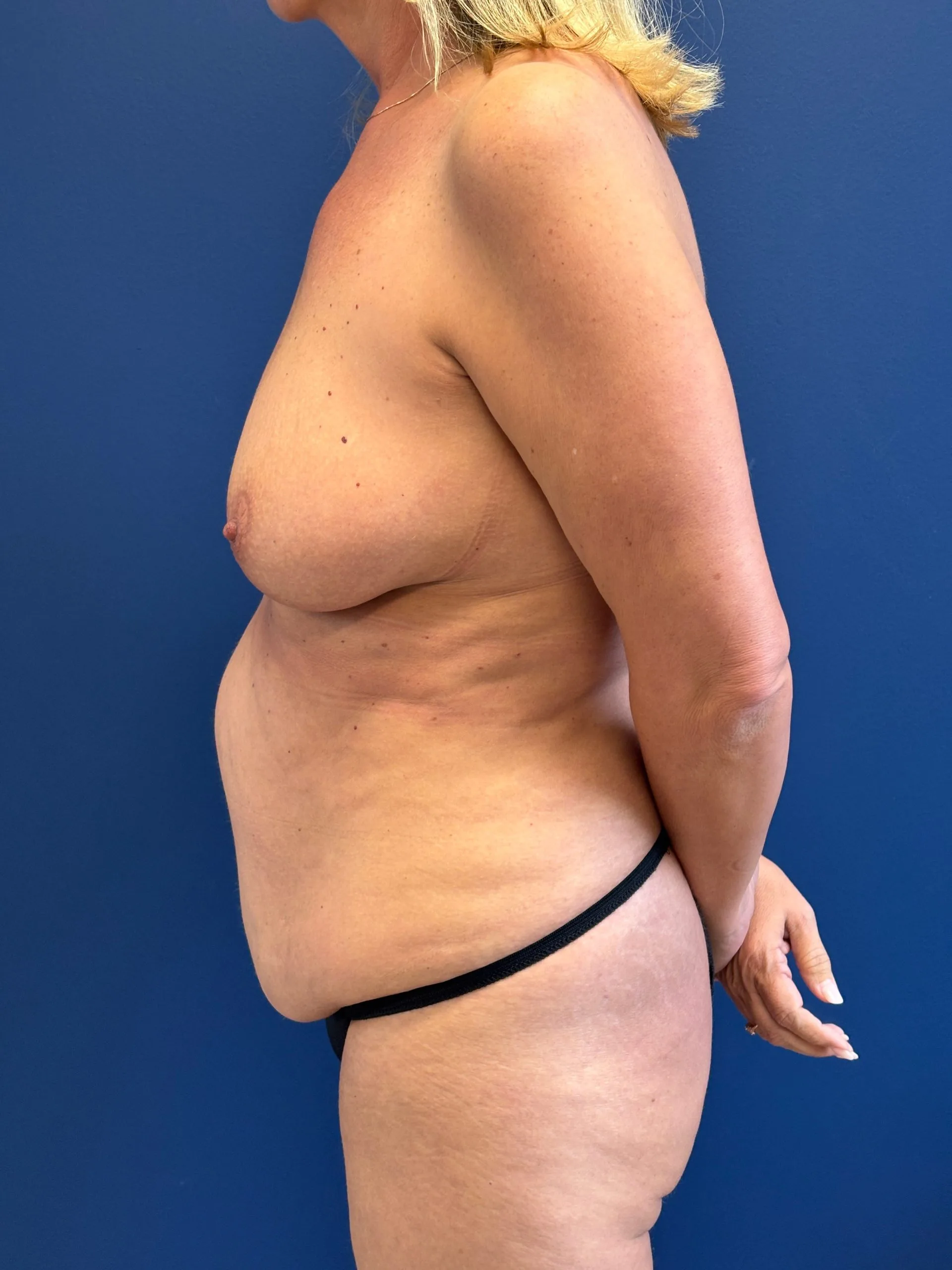 Abdominoplasty-Case--6263 | Before Tummy Tuck 2