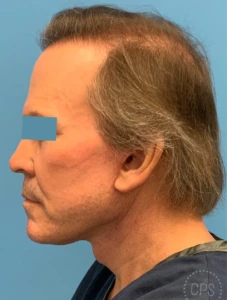 Men-Neck-Face-Lift-Case--23753 | After Facelift for Men 1